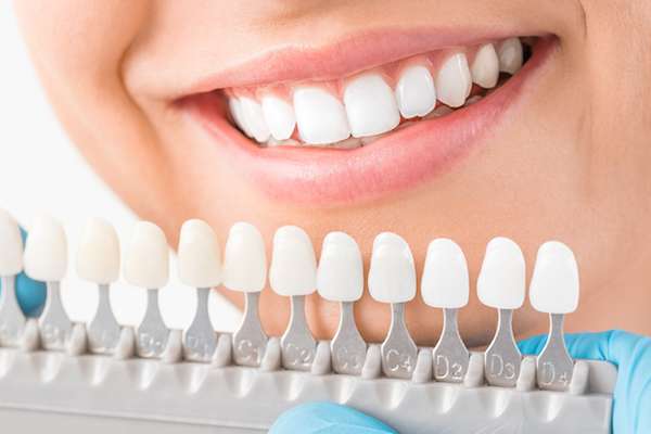 Ask a Cosmetic Dentist: What Are Veneers from GDC Smiles in Gainesville, GA