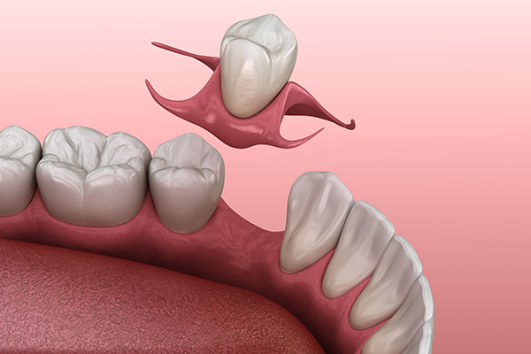 Partial Denture for One Missing Tooth: Can It be a Removable Denture? from GDC Smiles in Gainesville, GA