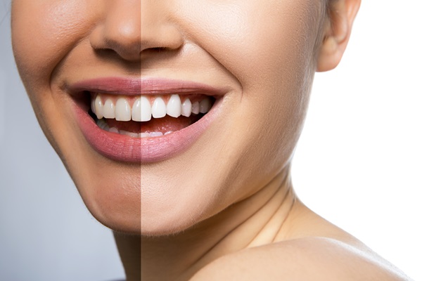 Cosmetic Dentistry Approaches To Teeth Whitening