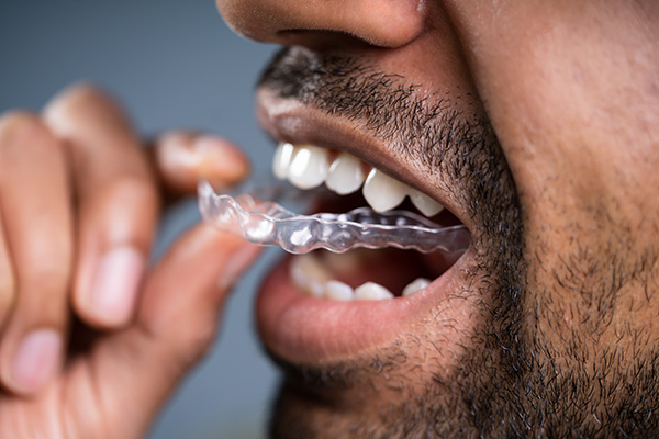 A Cosmetic Dentist Explains Benefits of Clear Aligners from GDC Smiles in Gainesville, GA