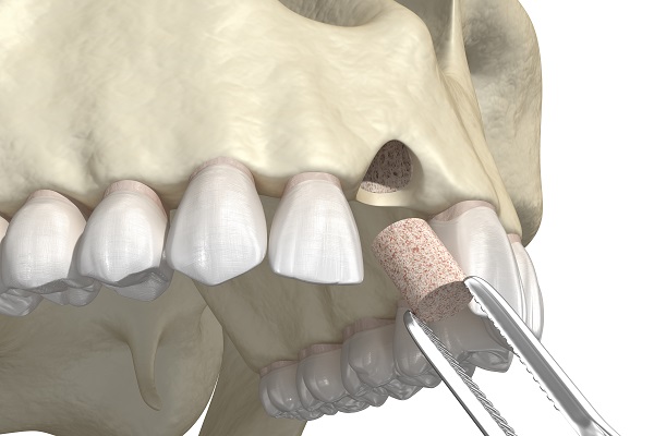Why You May Need To Get A Bone Graft Before Getting Dental Implants