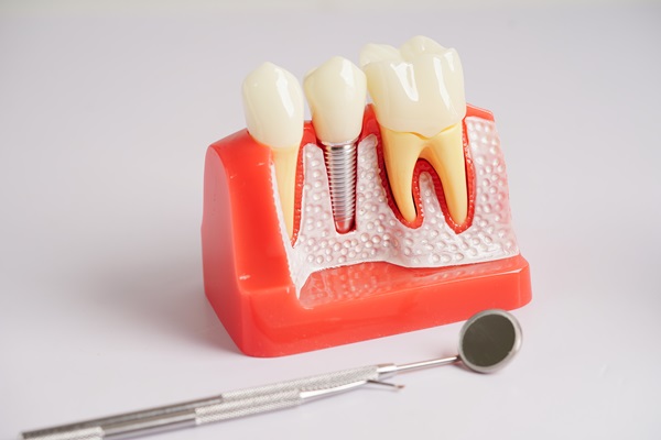 Can Dental Implants Replace Multiple Teeth?
