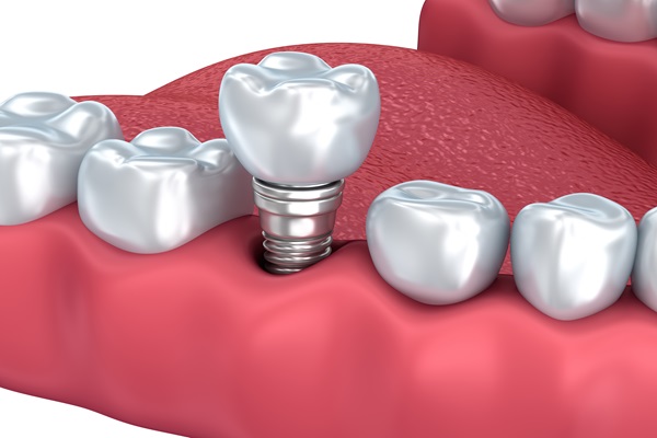 Bone Grafting For Dental Implant Placement