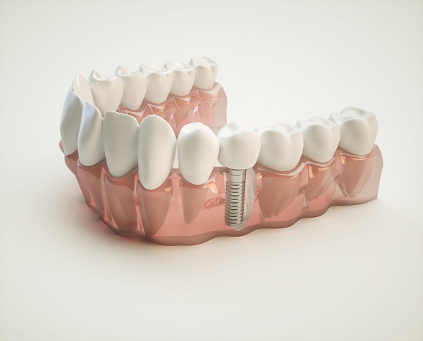 dental implant Gainesville, GA