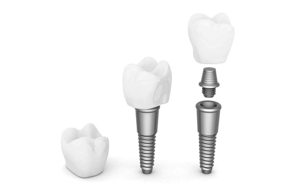 Dental Implants Gainesville, GA