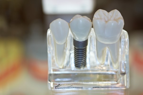 Dental Implants Gainesville, GA
