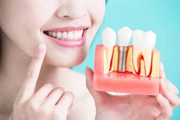 What Does The Process For Dental Implants Involve?