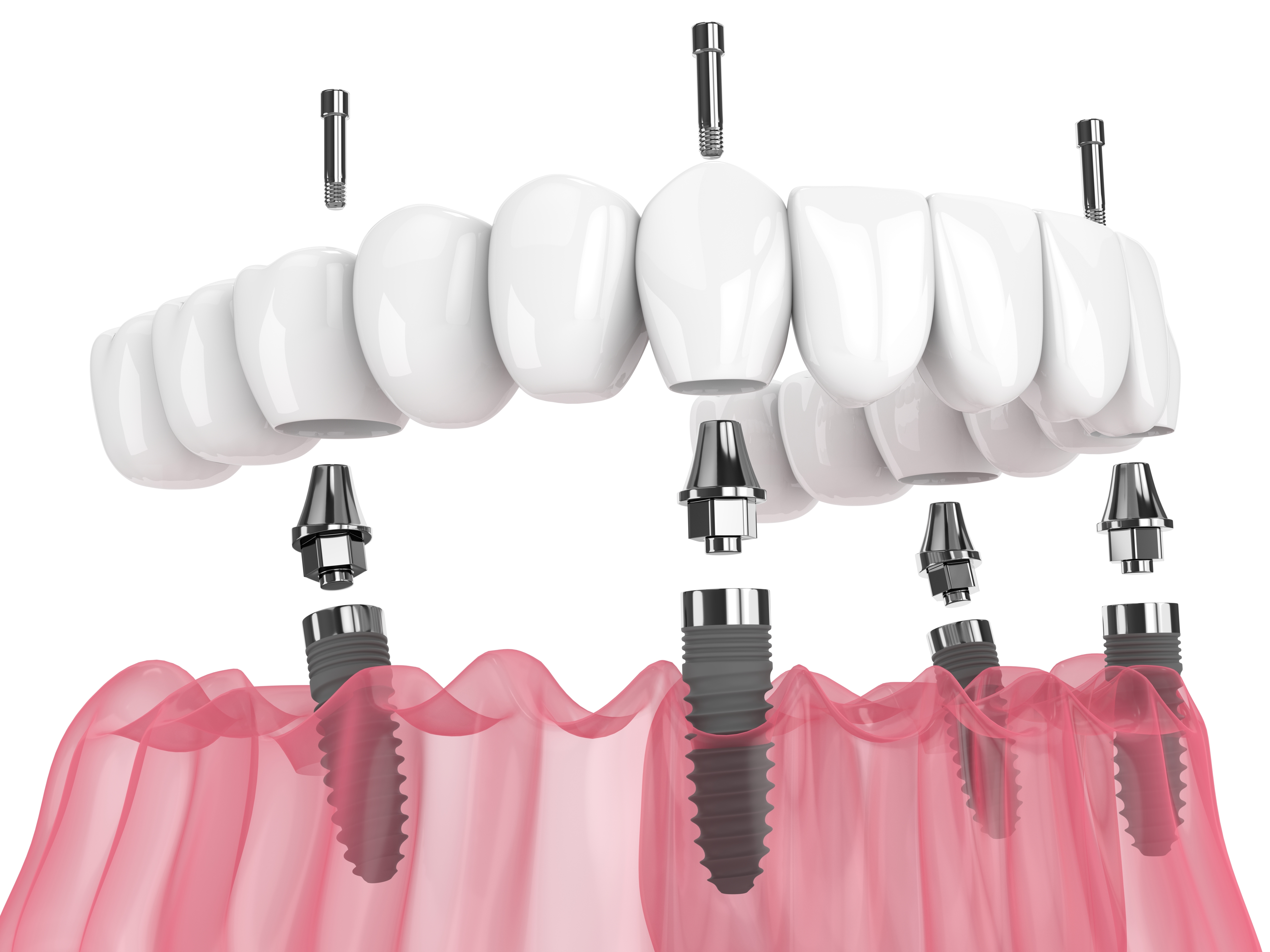 Getting Dental Implants For Dentures