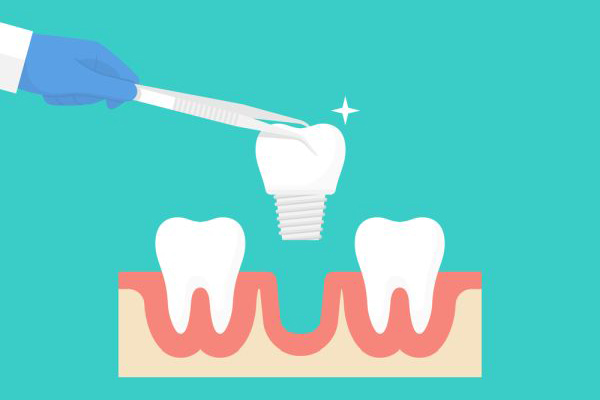 Choosing Dental Implants When You&#    ;re Missing More Than One Tooth