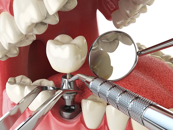 dental implant restoration Gainesville, GA