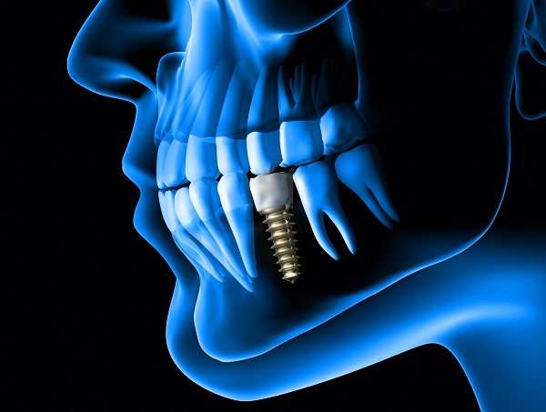 How To Care For A Dental Implant Restoration