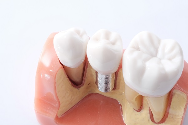 dental implants Gainesville, GA