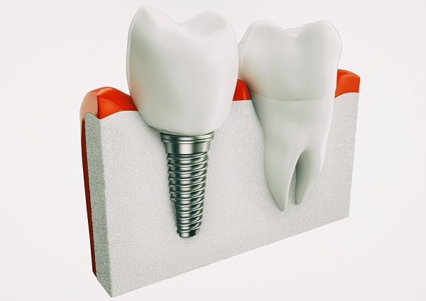 dental implant Gainesville, GA