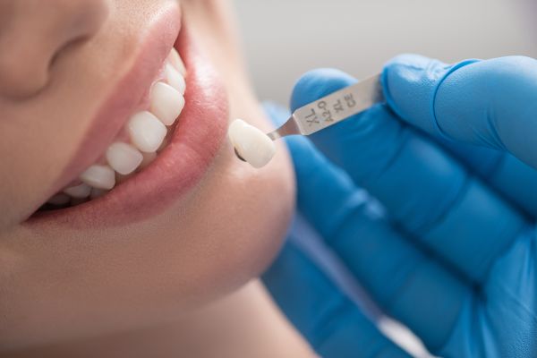 Dental Veneers: Making Your New Smile Last