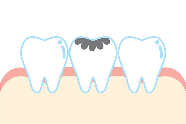Dental Practice FAQs: How Are Cavities Treated?