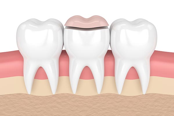 How a Cosmetic Dentist Can Place Inlays and Onlays from GDC Smiles in Gainesville, GA