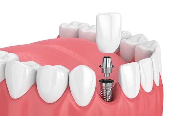 How Painful is Dental Implant Surgery from GDC Smiles in Gainesville, GA