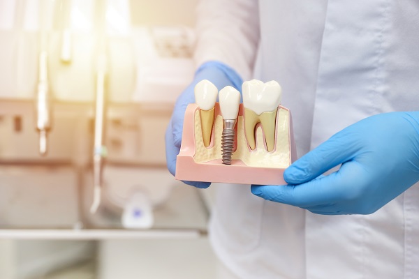 Should You Consider Getting Dental Implants?