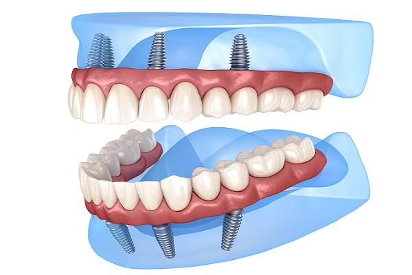 Implant Supported Dentures Gainesville, GA