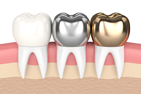 Metal Crowns vs. Porcelain Dental Crowns from GDC Smiles in Gainesville, GA
