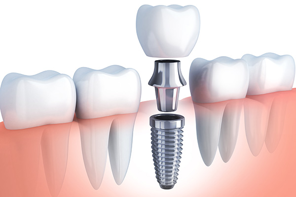 Questions to Ask Your Implant Dentist from GDC Smiles in Gainesville, GA