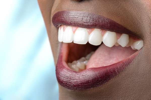 Routine Dental Care: What Are Tooth Colored Fillings from GDC Smiles in Gainesville, GA